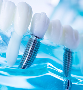 Dental Implants in Apple Valley MN, Dental Services in Apple Valley, MN